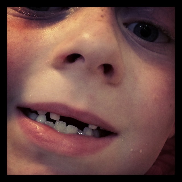 Lost tooth